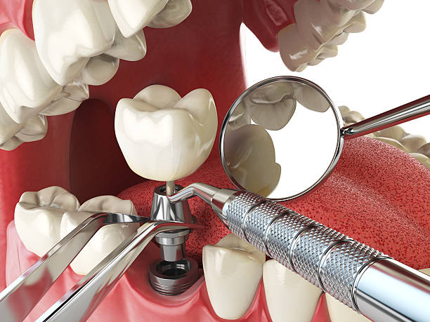 Best Emergency Tooth Extraction in Point Clear, AL